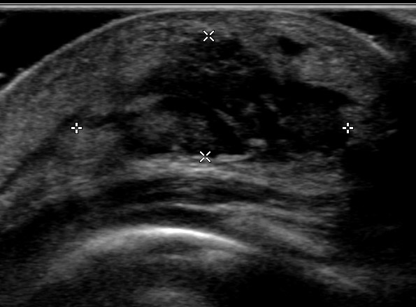 File:Neonatal mastitis with abscess (Radiopaedia 47089-51629 Transverse 1).jpg