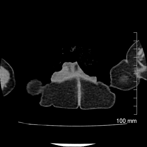 File:Neonatal neuroblastoma (Radiopaedia 56651-63438 Axial non-contrast 97).jpg