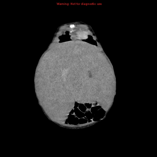 File:Neonatal neuroblastoma (Radiopaedia 9564-10223 B 28).jpg