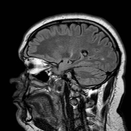 File:Neuro-Behcet's disease (Radiopaedia 21557-21506 Sagittal FLAIR 23).jpg