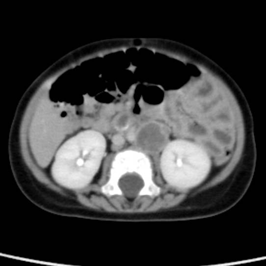 Neuroblastoma with skull metastases (Radiopaedia 30326-30960 C 32).jpg