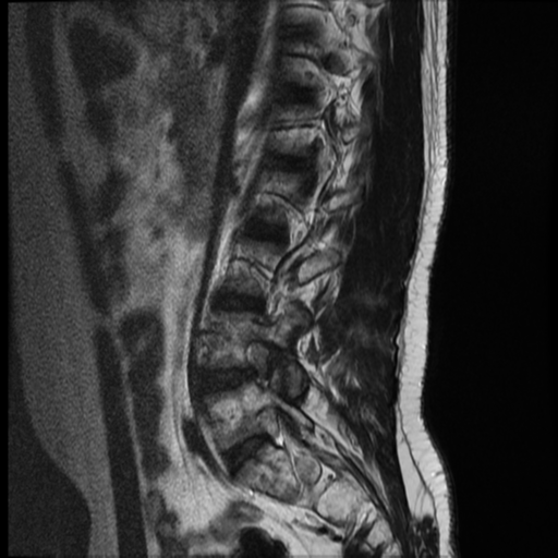 File:Neurofibromatosis type 2 (spinal manifestations) (Radiopaedia 53943-60070 E 12).png