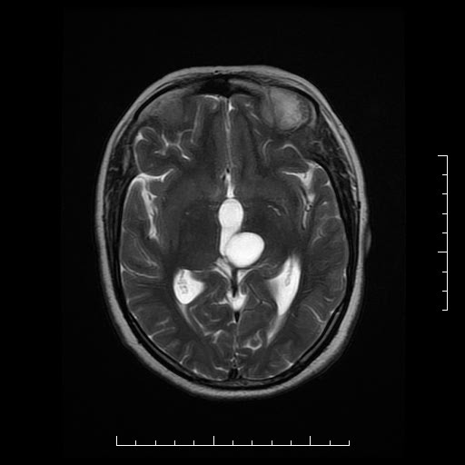 File:Neuroglial cyst of brainstem (Radiopaedia 29134-29526 Axial T2 10).jpg