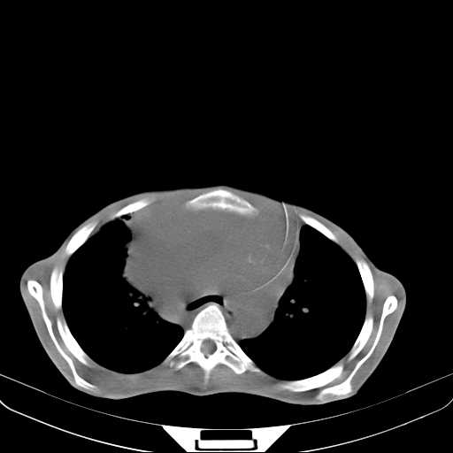 File:Non hodgkin lymphoma of the mediastinum (Radiopaedia 20814-20729 Axial non-contrast 12).jpg