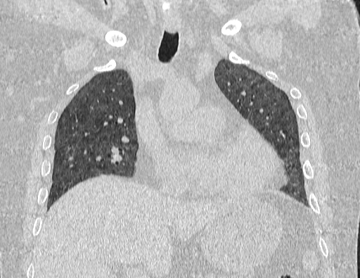 Non specific interstitial pneumonia (NSIP) (Radiopaedia 89725-106798 Coronal lung window 33).jpg