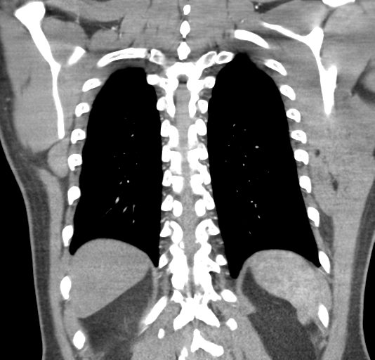File:Normal CTA thorax (non ECG gated) (Radiopaedia 41750-44704 B 68).png
