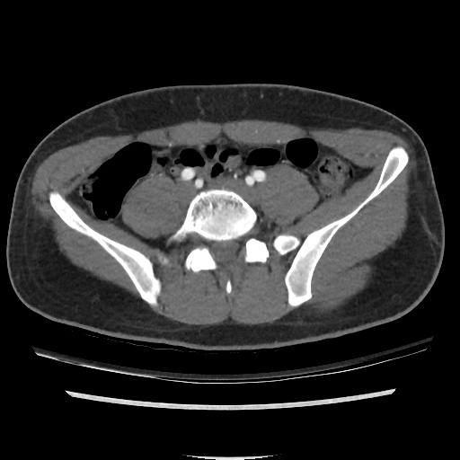 File:Normal CT angiogram of pelvis (Radiopaedia 45390-49430 A 23).jpg