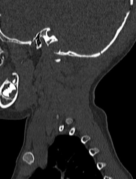 File:Normal CT cervical spine - pediatric (Radiopaedia 52549-58462 Sagittal bone window 1).jpg