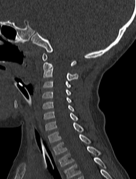 File:Normal CT cervical spine - pediatric (Radiopaedia 52549-58462 Sagittal bone window 86).jpg