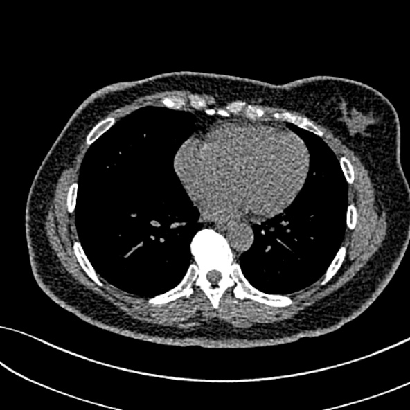 Normal CT chest- adult female (Radiopaedia 52522-58428 Axial non-contrast 85).jpg