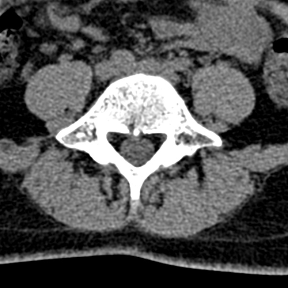 Normal CT lumbar spine (Radiopaedia 53981-60118 Axial non-contrast 77).jpg