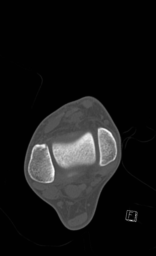 Normal CT of the ankle (Radiopaedia 47111-51658 Axial bone window 39).jpg