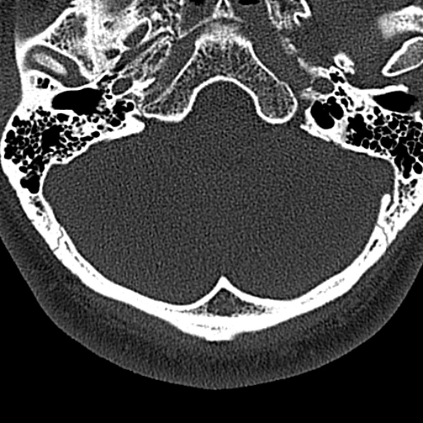 File:Normal CT of the cervical spine (Radiopaedia 53322-59305 Axial bone window 16).jpg