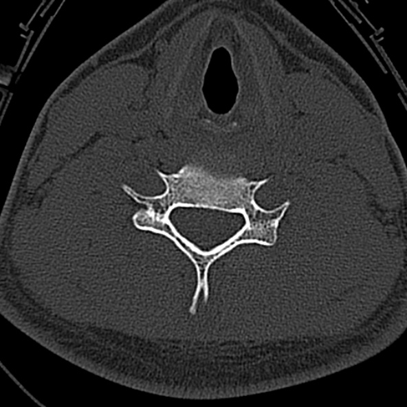 Normal CT of the cervical spine (Radiopaedia 53322-59305 Axial bone window 178).jpg