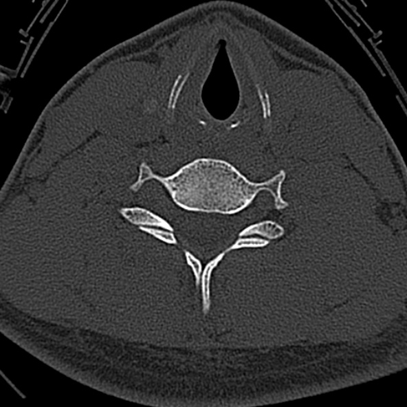 Normal CT of the cervical spine (Radiopaedia 53322-59305 Axial bone window 188).jpg
