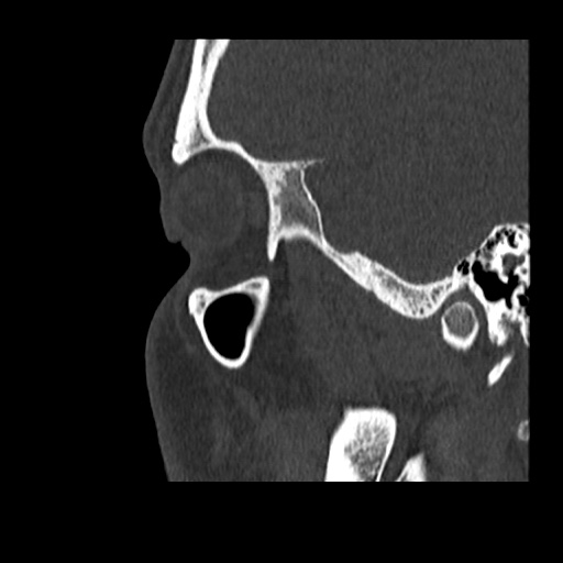 Normal CT paranasal sinuses (Radiopaedia 42286-45390 Sagittal bone window 12).jpg
