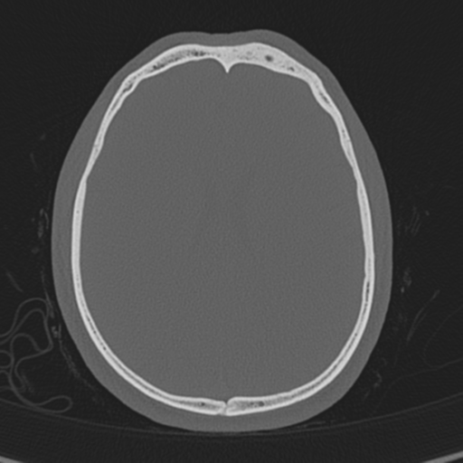 Normal CT skull (Radiopaedia 40798-43459 A 100).png