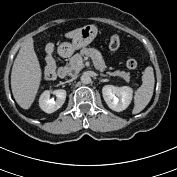 File:Normal CT split bolus study of the renal tract (Radiopaedia 48631-53634 Axial split bolus 52).jpg