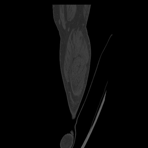 Normal CT tibia and fibula (Radiopaedia 51195-56848 Coronal non-contrast 63).jpg