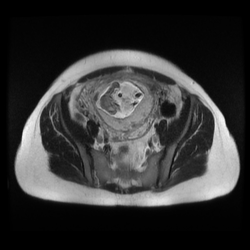 Normal MRI abdomen in pregnancy (Radiopaedia 88003-104546 Axial T2 35).jpg