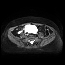 Normal MRI abdomen in pregnancy (Radiopaedia 88005-104548 Axial DWI 28).jpg