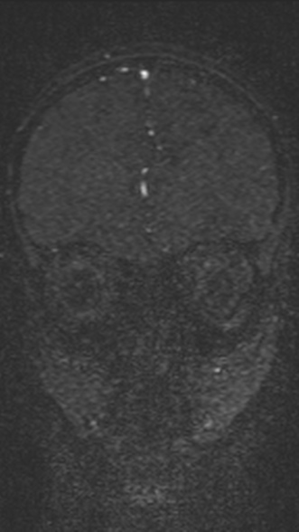 Normal MRI brain with MRV- teenager (Radiopaedia 49425-54553 Coronal MRV 75).jpg
