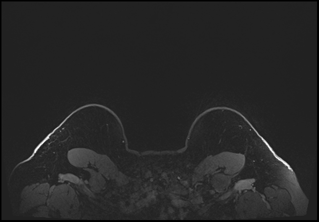 Normal breast MRI - dense breasts (Radiopaedia 80454-93850 C 221).jpg