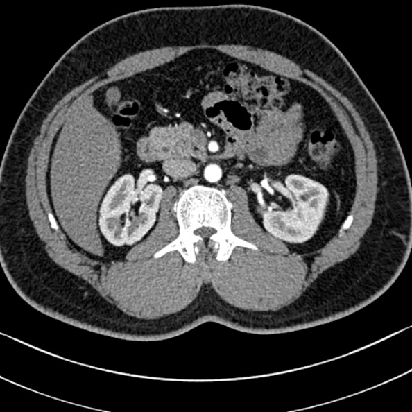 Normal kidneys on 4-phase CT study (Radiopaedia 25889-26038 B 35).jpg