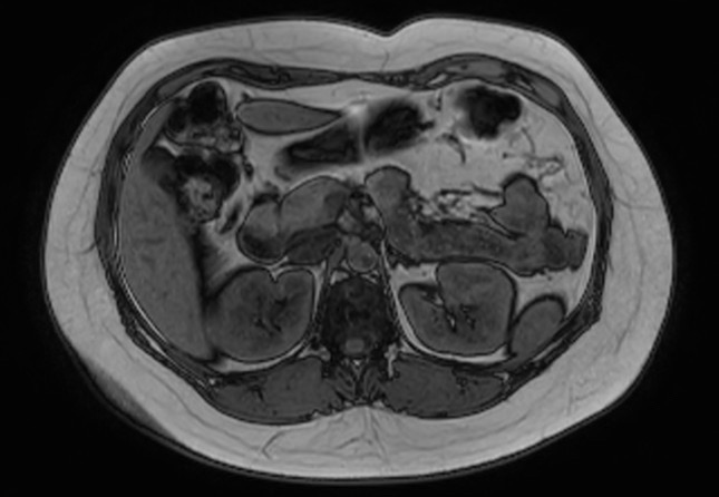 File:Normal liver MRI with Gadolinium (Radiopaedia 58913-66163 B 17).jpg