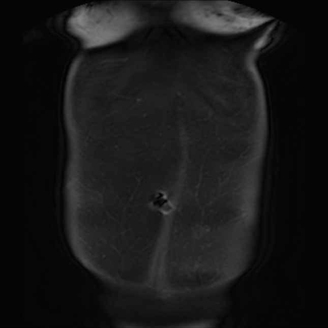 Normal liver MRI with Gadolinium (Radiopaedia 58913-66163 P 5).jpg