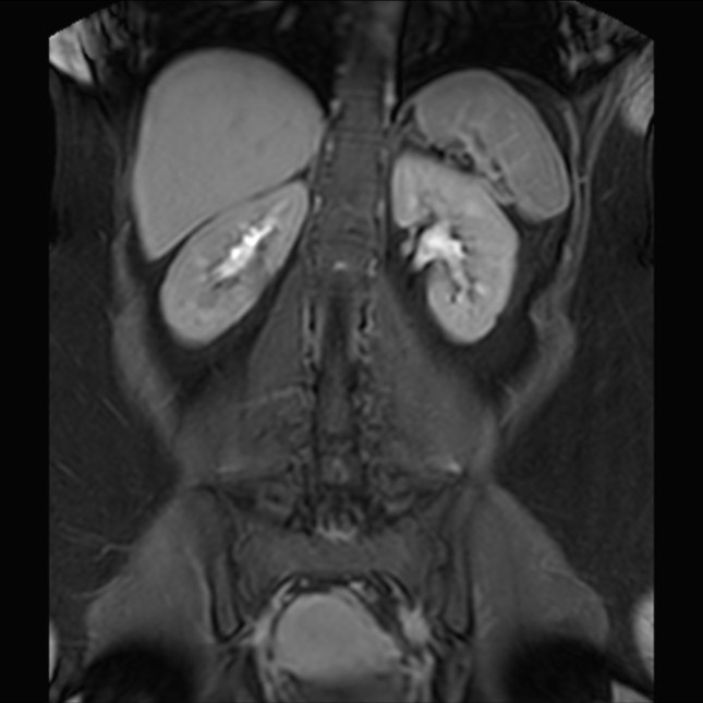 Normal liver MRI with Gadolinium (Radiopaedia 58913-66163 P 60).jpg