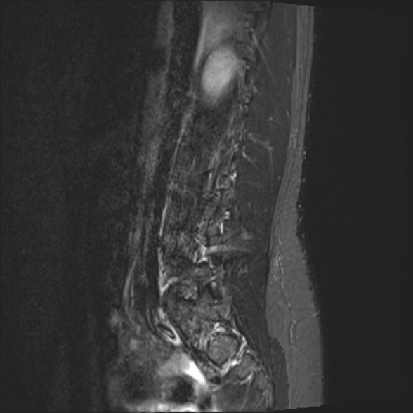 File:Normal lumbar spine MRI- 3 T (Radiopaedia 53280-59250 Sagittal STIR 6).jpg
