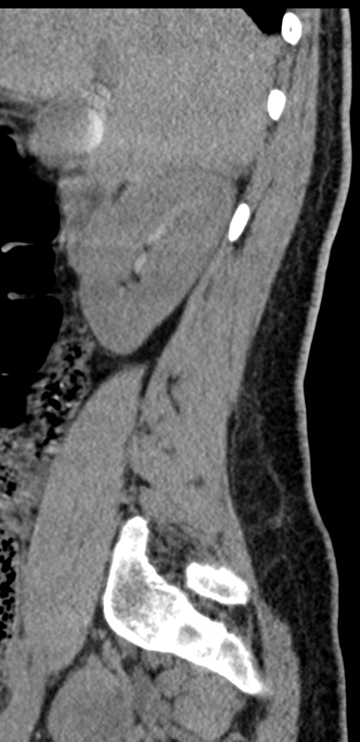 Normal lumbosacral CT (Radiopaedia 37923-39867 E 89).png