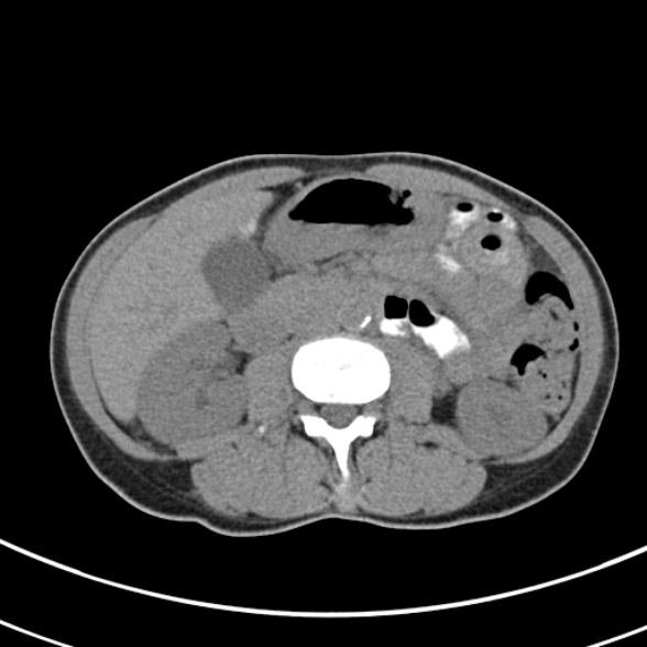 File:Normal multiphase CT liver (Radiopaedia 38026-39996 Axial non-contrast 38).jpg