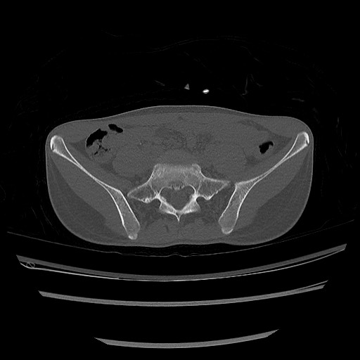Normal pelvis CT (Radiopaedia 51471-57236 Axial bone window 22).jpg