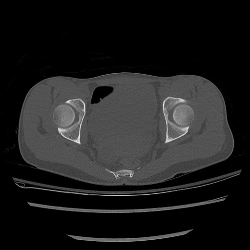 Normal pelvis CT (Radiopaedia 51471-57236 Axial bone window 67).jpg