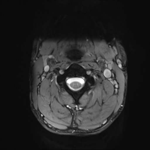 File:Normal trauma cervical spine (Radiopaedia 41017-43762 Axial T2 6).png