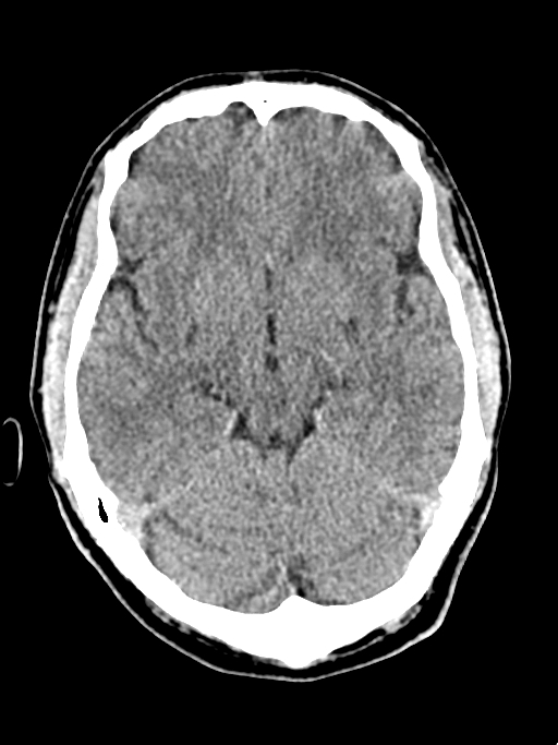 Normal trauma protocol brain and C-spine CT (Radiopaedia 83302-97709 Axial non-contrast 46).jpg