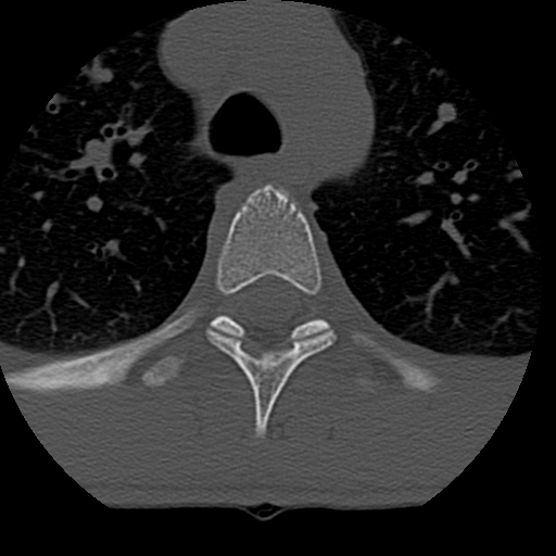 File:Normal trauma spine imaging (age 16) (Radiopaedia 45335-49358 Axial bone window 104).jpg