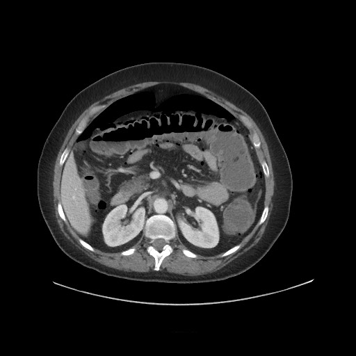 Obstructive distal colonic adenocarcinoma causing cecal perforation (Radiopaedia 86830-102989 A 74).jpg