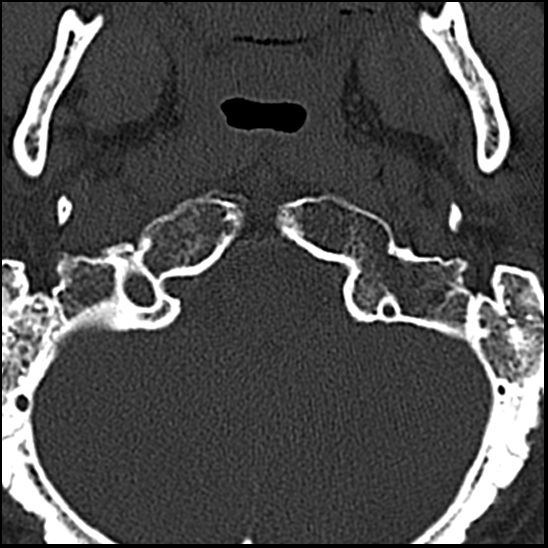 Occipital condyle fracture (type 1) (Radiopaedia 87670-104084 Axial bone window 8).jpg