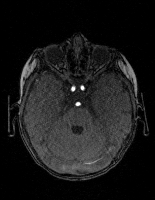 Occipital horn syndrome (Radiopaedia 14255-14129 MRA 49).jpg