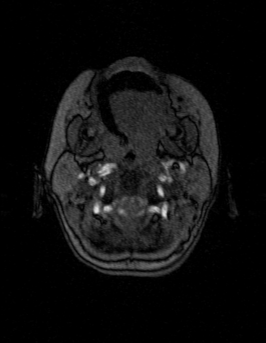 Occipital horn syndrome (Radiopaedia 14255-14129 MRA 6).jpg