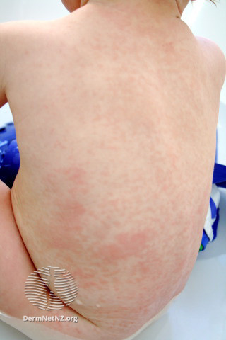 File:Rubella rash (DermNet NZ viral-rubella2).jpg