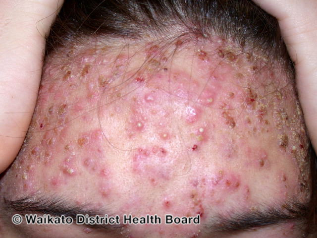 File:Severe acne of forehead (DermNet NZ acne-055).jpg