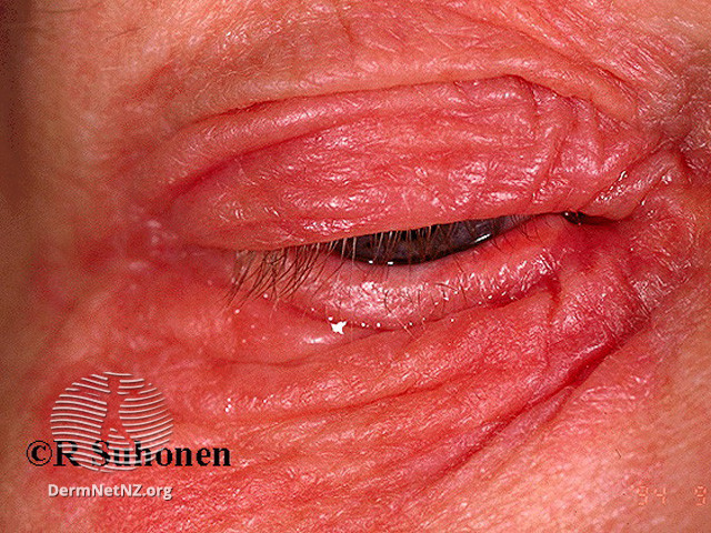 File:Severe acute eyelid dermatitis (DermNet NZ dermatitis-s-eyelid-dermatitis-03).jpg