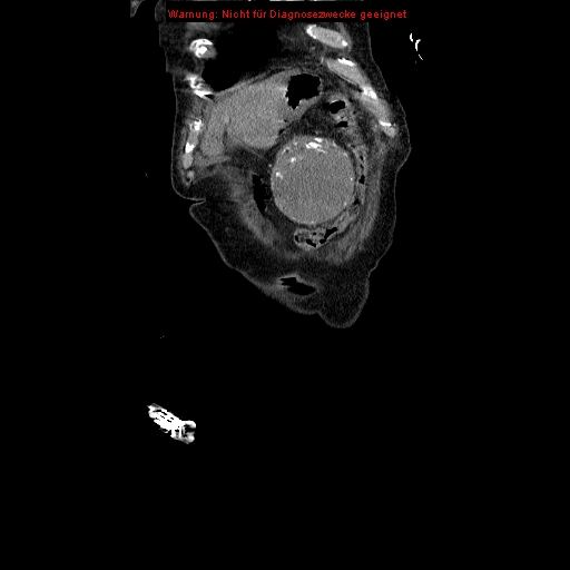 Abdominal aortic aneurysm- extremely large, ruptured (Radiopaedia 19882-19921 Coronal C+ arterial phase 12).jpg