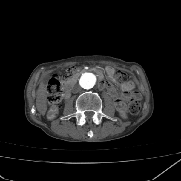 Abdominal aortic aneurysm (Radiopaedia 23703-23856 Axial C+ arterial phase 38).jpg