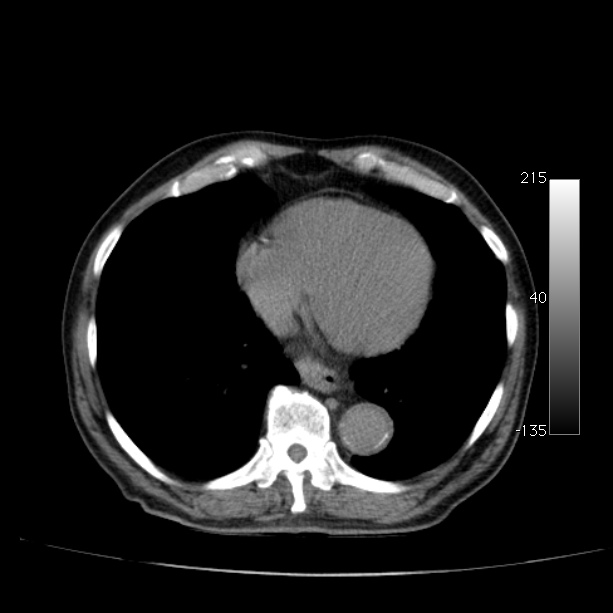 Abdominal aortic aneurysm (Radiopaedia 29248-29660 Axial non-contrast 4).jpg