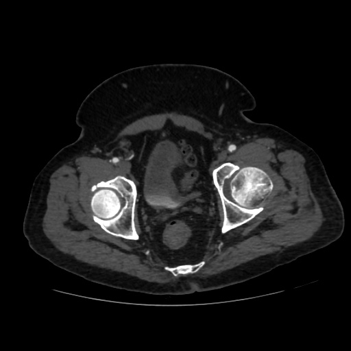 File:Abdominal aortic aneurysm (Radiopaedia 57318-64259 Axial C+ arterial phase 70).jpg